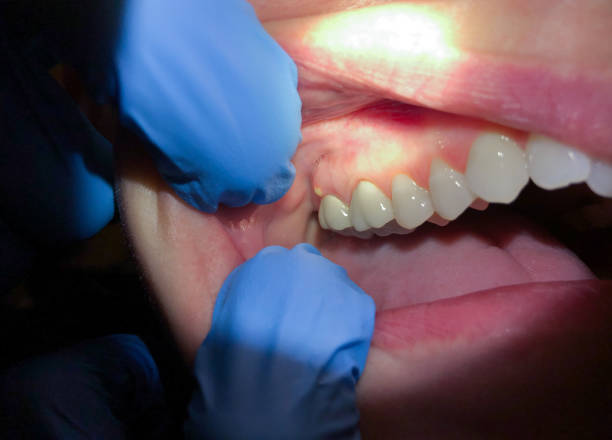 Best Emergency Wisdom Tooth Extraction in Cedar Grove, WI